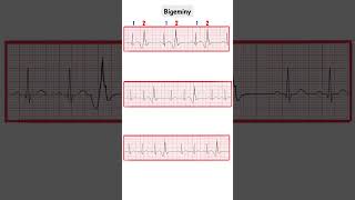 Premature ContractionsBigeminy Trigeminy QuadrigeminyECGMadeEasy ecg doctor medicine cardio [upl. by Ciccia478]