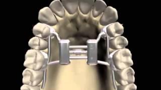 O aparelho no céu da boca disjuntor palatino [upl. by Aggappera]
