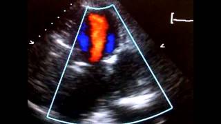 Echocardiogram Pseudoaneurysm Inferolateral LV [upl. by Ettennig702]