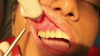 Administration of dental local anaesthesiabuccal infiltration technique endodontics dentistry [upl. by Jonathon]