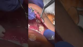 Baby tooth dental Abscess and Band and Loop space maintainer [upl. by Eatnuahc835]