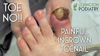 TOE NO Painful Ingrown Toenail Removal [upl. by Netsyrk]