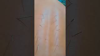 dry needling therapy dryneedling therapy [upl. by Abixah110]