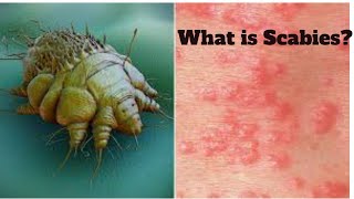 what is scabies sign symptomscauses and treatment [upl. by Zackariah]