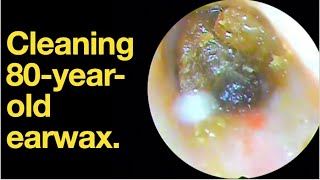 Cleaning 80yearold earwax ear wax removal  ear cleaning  ASMR  relaxation  relax [upl. by Piderit35]