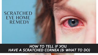 Scratched eye home remedy  HOW TO TELL IF YOU HAVE A SCRATCHED CORNEA amp WHAT TO DO [upl. by Araet]