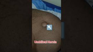 Umbilical Hernia Umbilical hernia showing video  pregnant ultrasound medical baby shorts usg [upl. by Janel451]