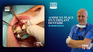 Mise en place dun implant dentaire  Dr Barjou [upl. by Eojyllib]