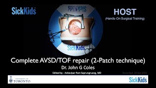 Complete AVSDTOF repair 2Patch techniqueDrJohn ColesFull VDO [upl. by Ecirtahs]