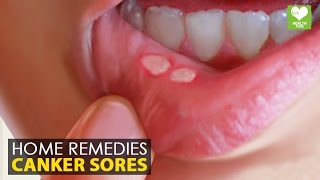 Canker Sores  Home Remedies Natural Treatment  Health Education [upl. by Halfon184]