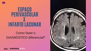 Espaço perivascular x infarto lacunar o DIAGNÓSTICO diferencial [upl. by Eceerahs]