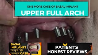 fix your teeth in 72 hours with basal implantsPatients honest reviews after fixing new teeth [upl. by Anecuza]