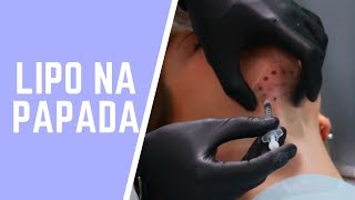 LIPO DE PAPADA ENZIMÁTICA [upl. by Carolin]