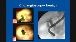 Primary Sclerosing Cholangitis Update in Management [upl. by Esetal]