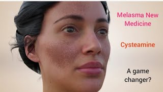 Melasma New Medicine  Cysteamine  Is it a game changer melasma melasmacream melasmatreatment [upl. by Eycats996]