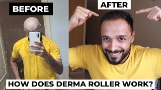 Derma Roller hair regrowth before and after  Does Microneedling actually work in reducing DHT [upl. by Denton]