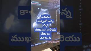 Breech presentation in 9th month drkranthigynecologist తొమ్మిదవ నెల లో ఎదురు కాళ్ళు [upl. by Neeroc]