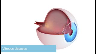 Vitreous body diseases Causes symptoms diagnosis amp treatment Essentials in 3 minutes [upl. by Yramanna]