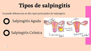 Salpingitis Crónica [upl. by Caldeira]