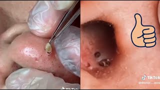 30 Min of the Most Satisfying Pimple Pops amp Cyst Extractions  Ultimate Pimple Popping Compilation [upl. by Eelana]