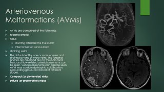 Brain vascular malformations [upl. by Haynes]