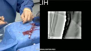 CTO IVA PAR CD PAR TECHNIQUE DE REVERSE CART [upl. by Tem246]