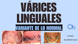 Variante de lo normal VARICES LINGUALES [upl. by Eelesor]