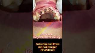 Root Canal Treatment  Teeth Reconstruction  Post and Core Build Up [upl. by Assirralc]