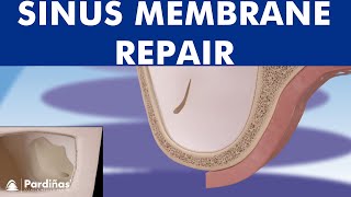 Sinus membrane perforation repair © [upl. by Kirwin]