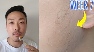 WEEK 7 MINOXIDIL BEARD GROWTH VELLUS HAIRS [upl. by Verney]