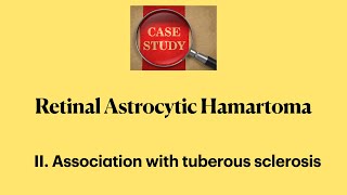 Retinal Astrocytic Hamartoma IIAssociation with tuberous sclerosis [upl. by Holmann]