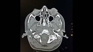 Otitis media and acute mastoiditis [upl. by Aiello]