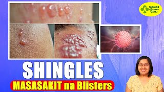 MASAKIT na Blisters Dulot ng SHINGLES  Varicella Zoster Virus  Tagalog Health Tips  Nurse Dianne [upl. by Ecnahs556]