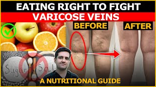 Best Diet To Cure Varicose Veins  Dr Gaurav Gangwani Interventional Radiologist [upl. by Talbot]