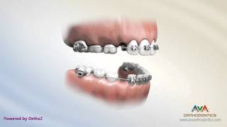 Orthodontic Treatment for Kids  2x4 Braces [upl. by Keram]