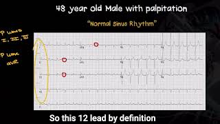 What defines a true normal sinus rhythm on a 12lead ECG [upl. by Crain]