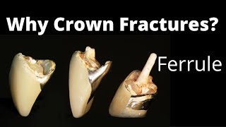 Why dental Crown Fails Ferrule Effect post amp Core Prosthodontics basic Lectures [upl. by Cirenoj]