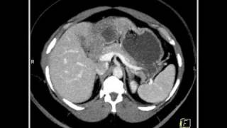 Abdomen Liver Hemangioma of the Liver8 of 8 [upl. by Raleigh]