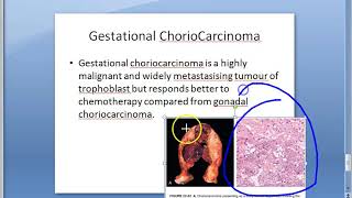 Pathology 750 b ChorioCarcinoma Placenta Gestational hCG tumor malignant molar pregnancy [upl. by Eveleen]