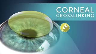 Keratoconus Crosslinking  Holcomb C3R is First Epion NonInvasive 20 Year Track Record shorts [upl. by Velasco]