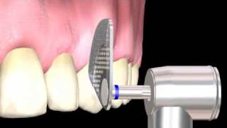 Using the KOMET OS30 oscillating handpiece [upl. by Adebayo]