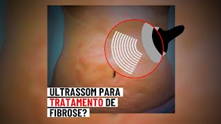 Ultrassom é uma boa opção para o tratamento de fibrose Pergunte 138 [upl. by Olraced]