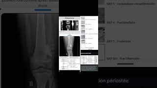 Ostéosarcome  Stade Réaction Périostée SRP [upl. by Atig]