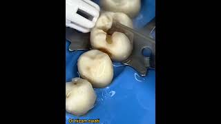 dental teeths filing procedure [upl. by Heiner]