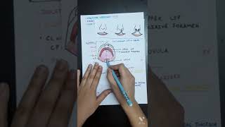 Amazing final smile for cleft lip and palate patient after orthodontic treatment [upl. by Naggem]