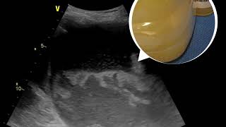 How empyema thoracic or lung abscess can be seen from bedside ultrasound [upl. by Blankenship]