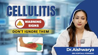 Cellulitis Alert  Dont Ignore These Cellulitis Symptoms  Dr Aishwarya  KBK Hospitals [upl. by Wynnie]