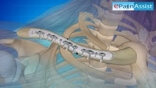 Broken Collarbone Surgery 3D Video Plates amp Screws Pins Bone Graft amp Fixation [upl. by Kreis]