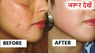 चेहरे पर क्यों पड़ती झाइयां कैसे करें इन्हें जड़ से खत्म  Pigmentation Treatment In Hindi [upl. by Aiciruam]