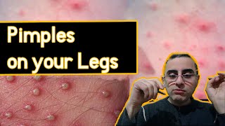 Pimples on The legs  Funiculitis Causes treatment prevention [upl. by Annawik]